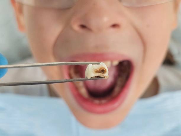 Best Emergency Treatment for Dental Infections or Abscesses in West Siloam Springs, OK